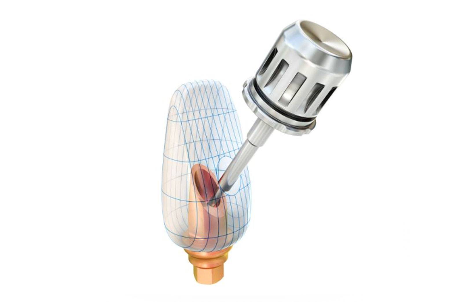 TRI Dental Implants Start